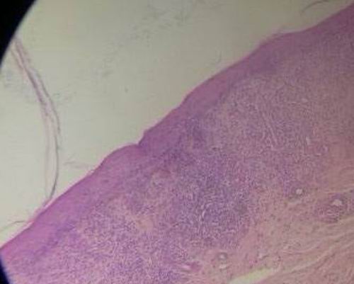 Imagen microscpica del liquen plano - Denso infiltrado crnico en banda debajo de la epidermis.
Ausencia de paraqueratosis
Cuerpos de Civatte no bien definidos.
ocular 10. objetivo 20. Col. H-E